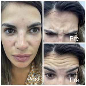 أفضل دكتور حقن بوتكس في رأس غارب